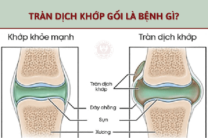 Cách chữa tràn dịch khớp gối bằng phương pháp Đông Y
